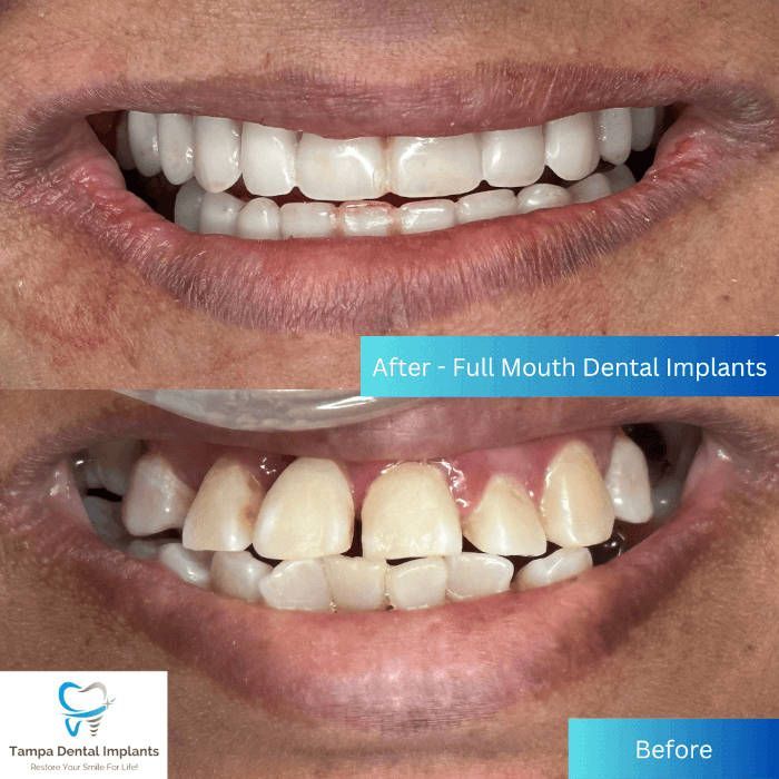 before and after upper full arch dental implants