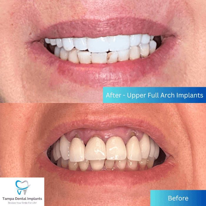 after-full arch implants