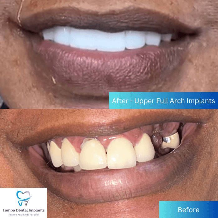 after- upper full arch implants