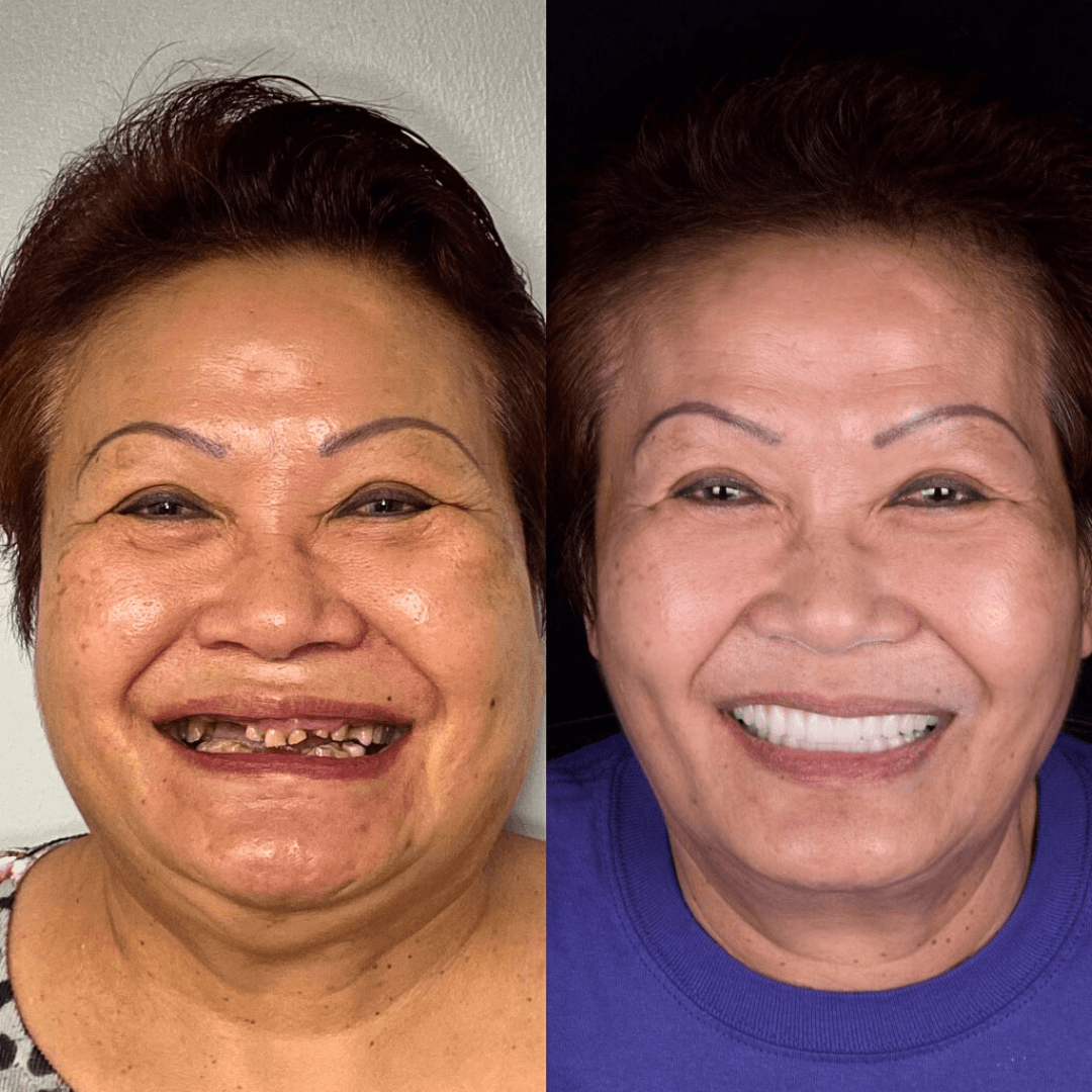 dental implants tampa before and after