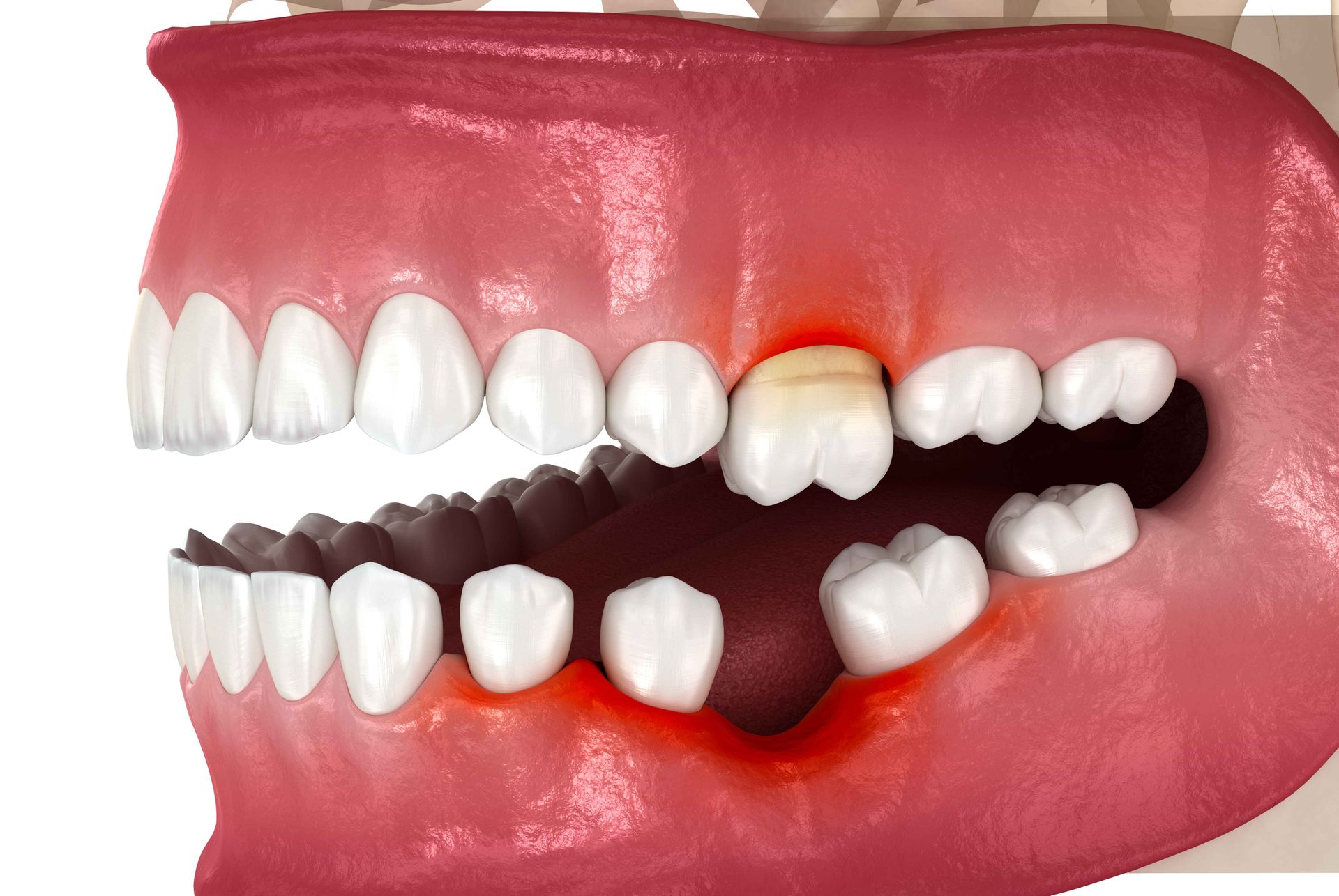teeth-missing-tooth