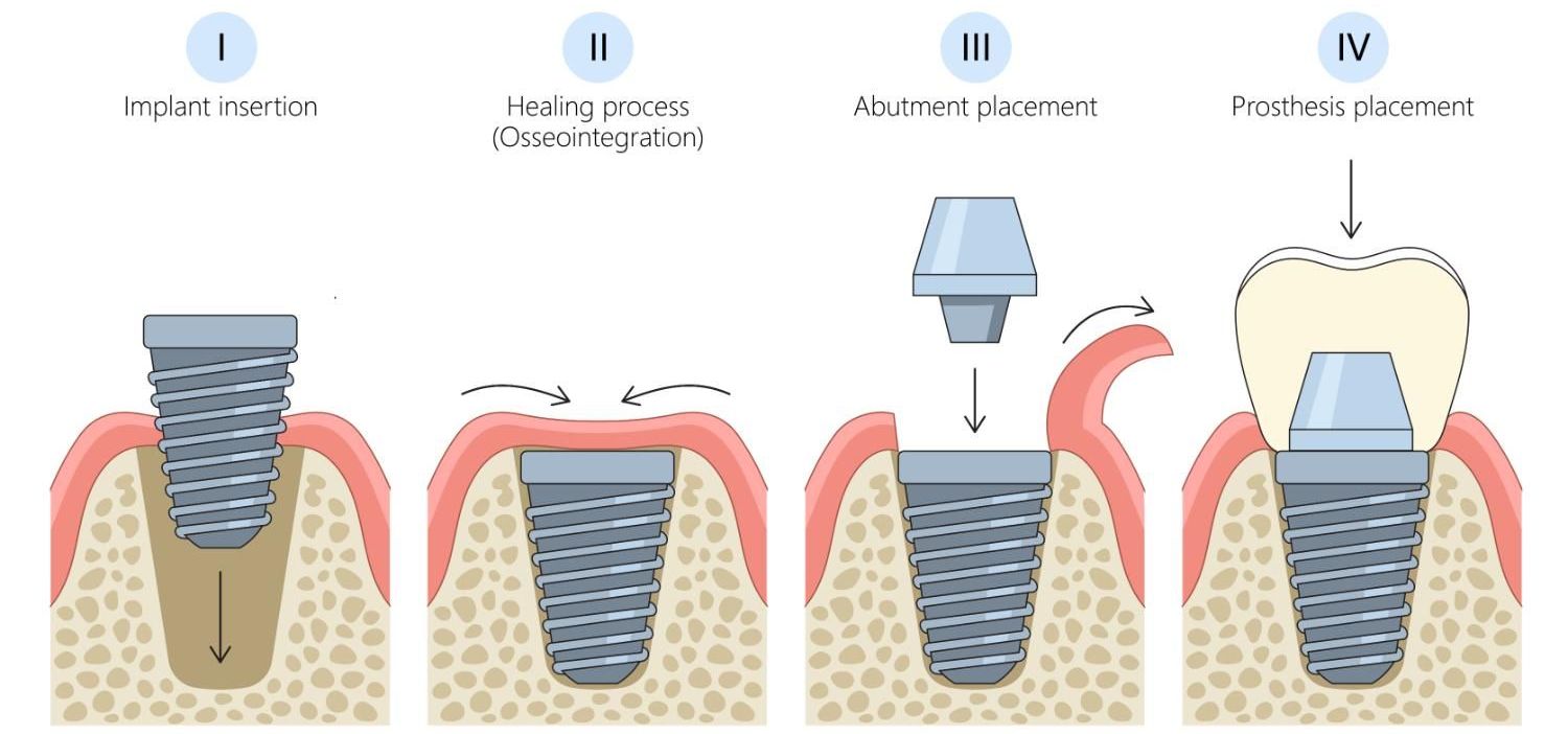 A diagram of a dental implant being placed in a tooth