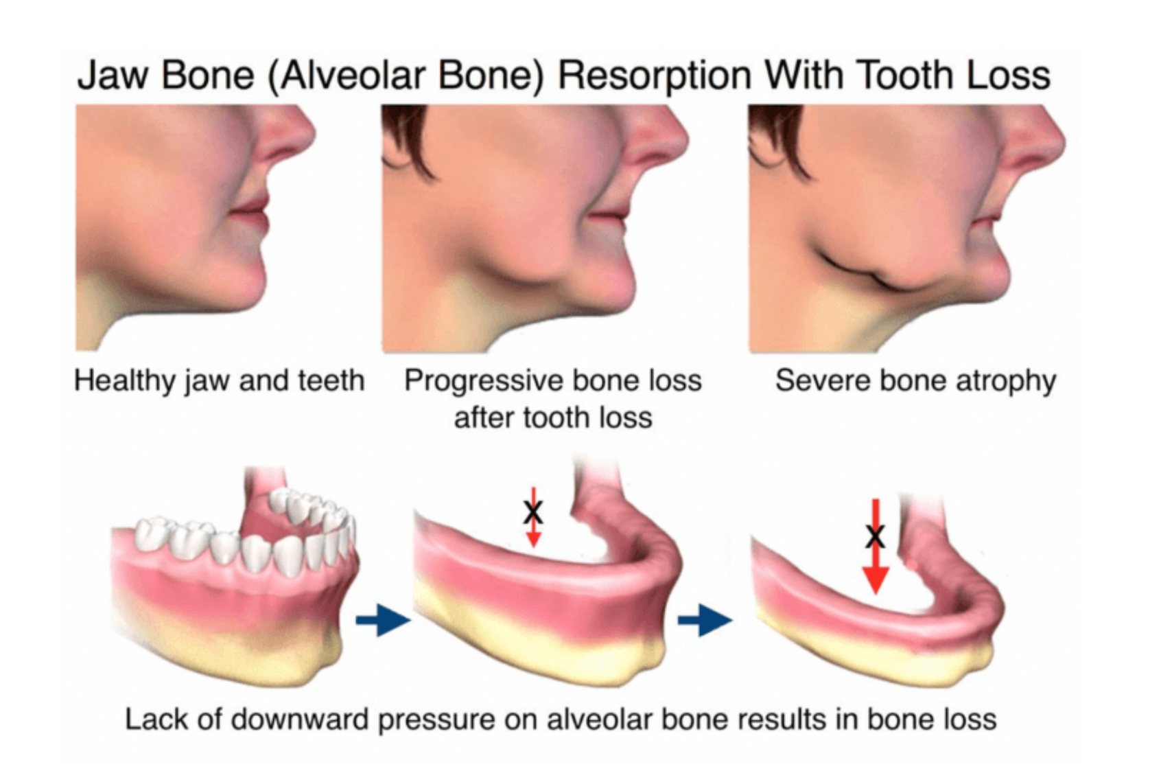Regular dentures cause long term bone loss in your jaw.
