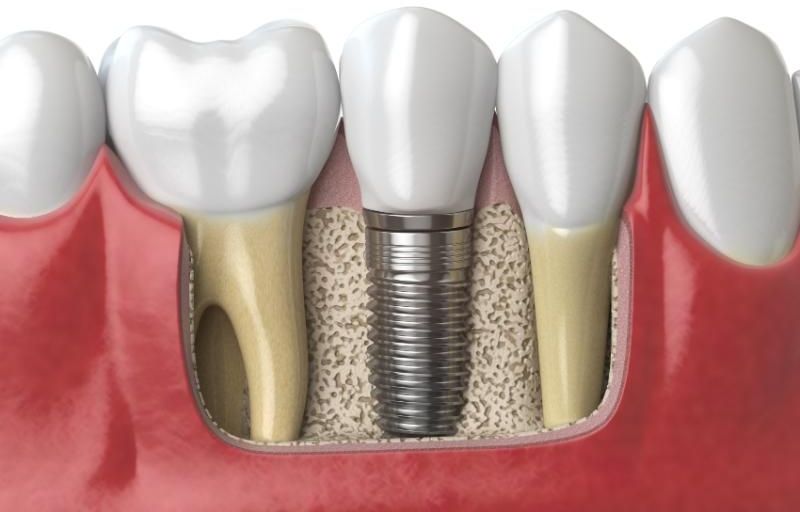 dental implant with the surrounding jawbone