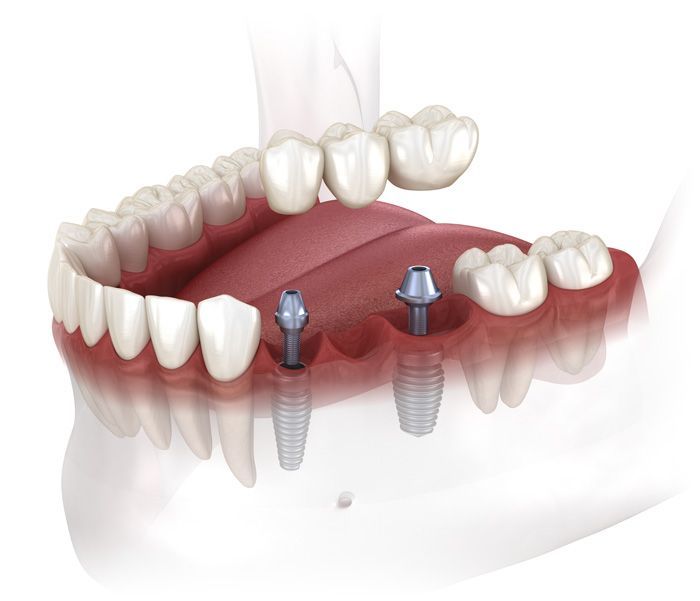 implant bridge