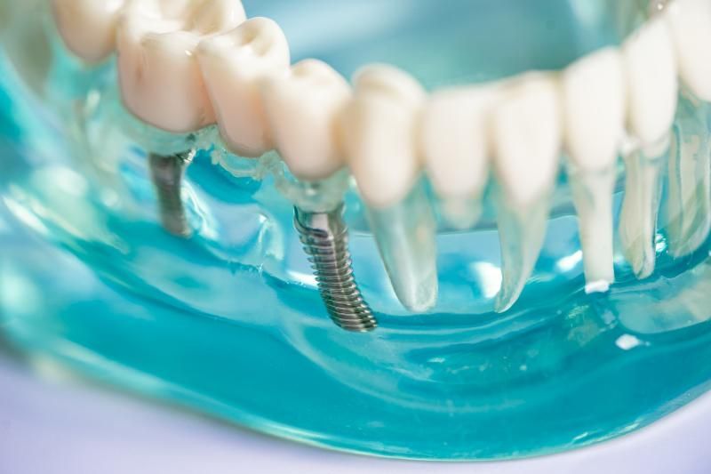 dental implant tooth