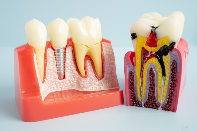 A model of a tooth with a dental implant and a model of a tooth without a dental implant.