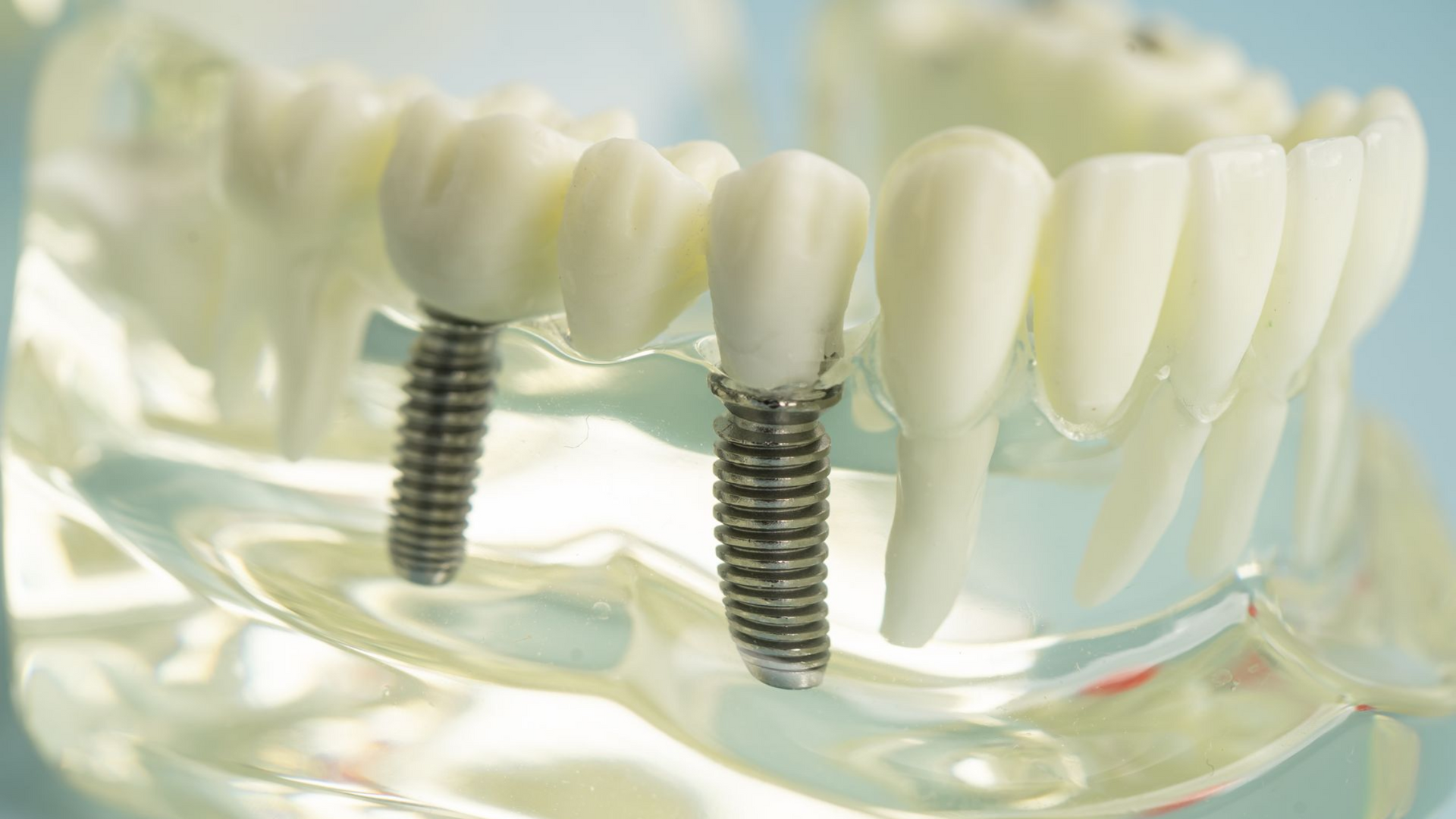 Dental model with two artificial teeth attached to screw implants.