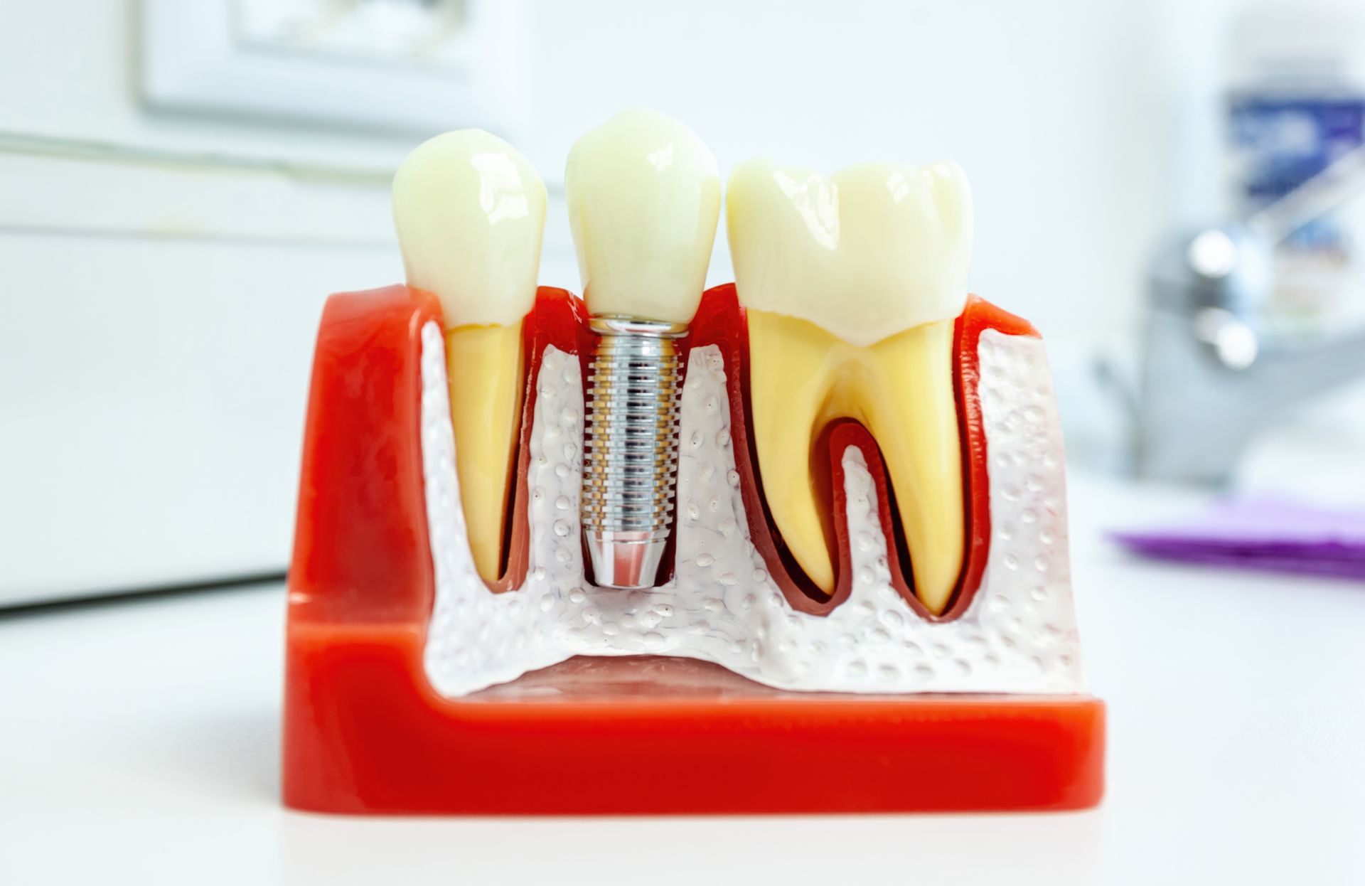 Dental implant model showing three teeth with one titanium implant in red gum tissue
