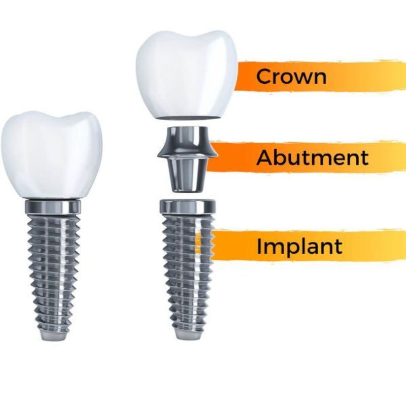 A diagram showing the parts of a dental implant