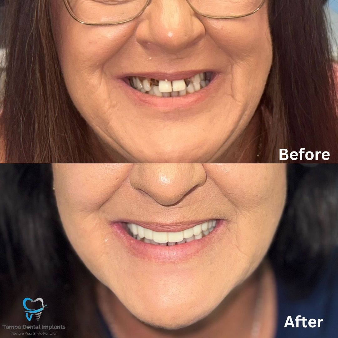 Dental Implants