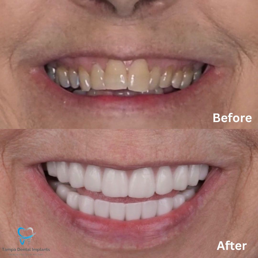 Dental Implants