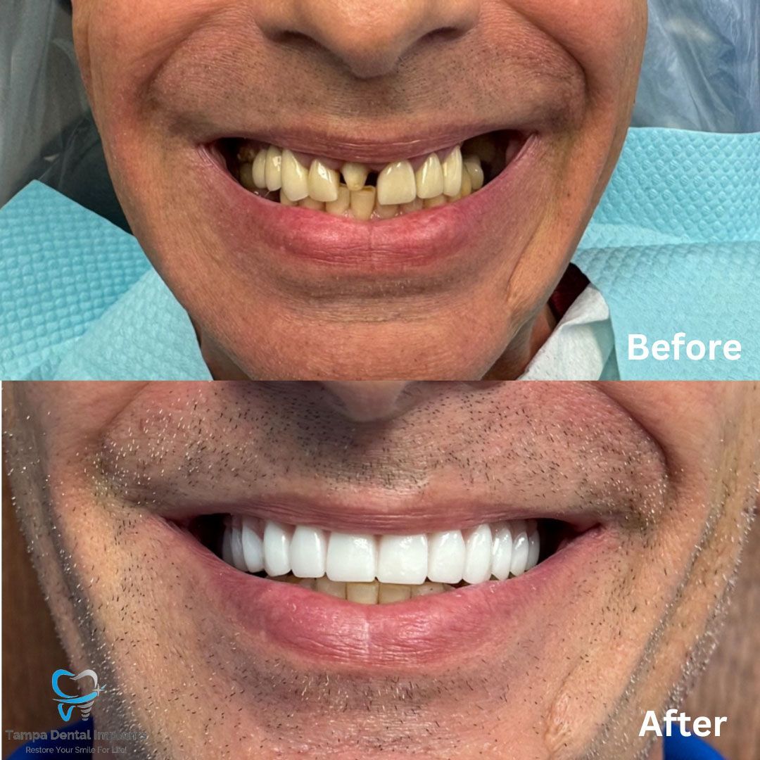 Dental Implants