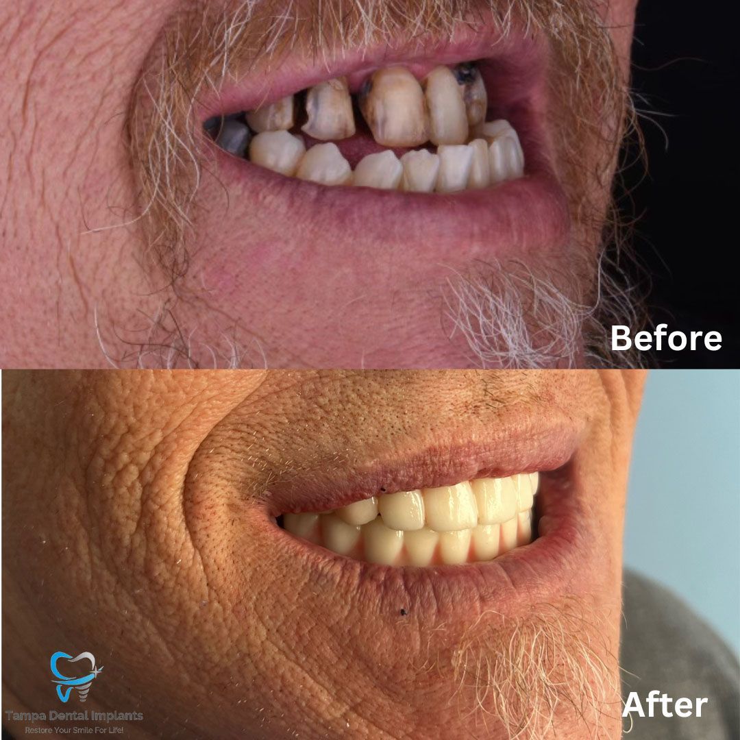 Dental Implants