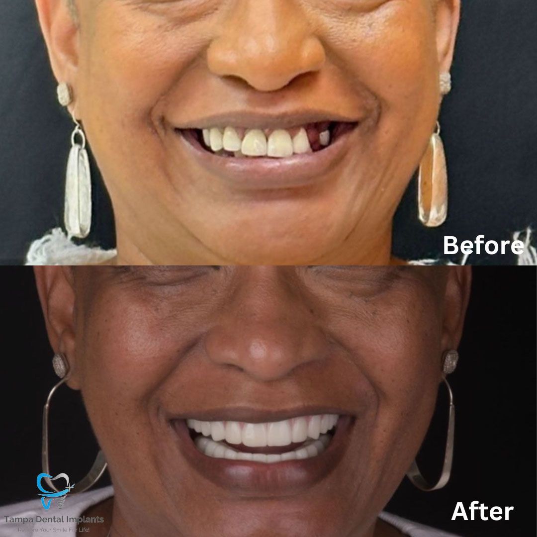 Dental Implants