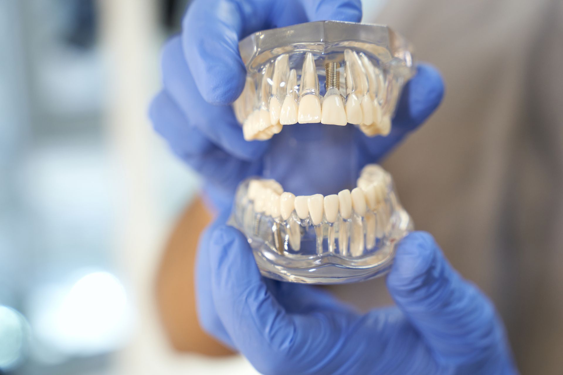 A pair of hands in blue medical gloves holds a transparent dental model of human teeth.
