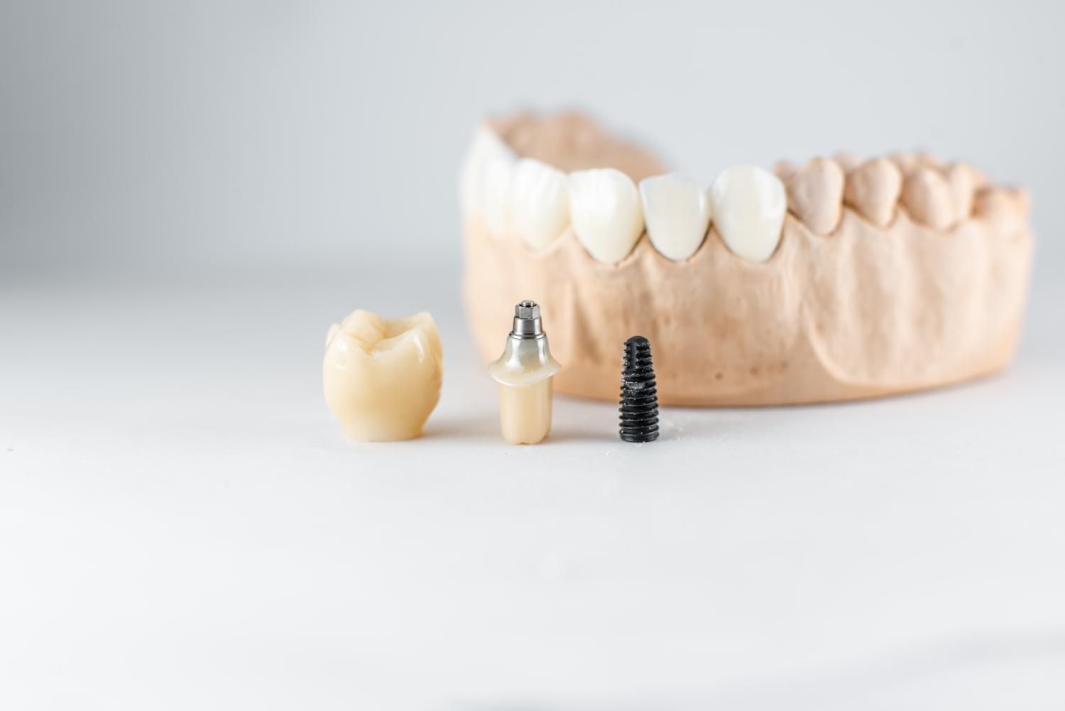 A model of a person 's teeth with a dental implant in the middle.