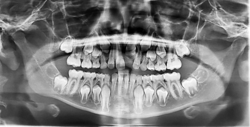 A black and white x-ray of a person 's teeth.