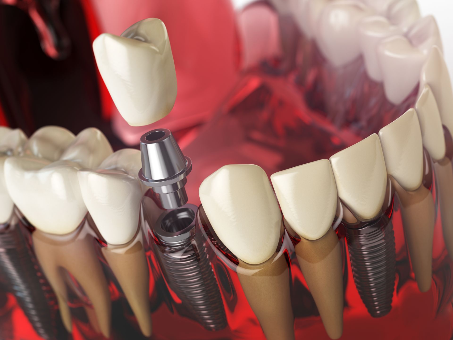 A model of a dental implant with a crown coming out of it.