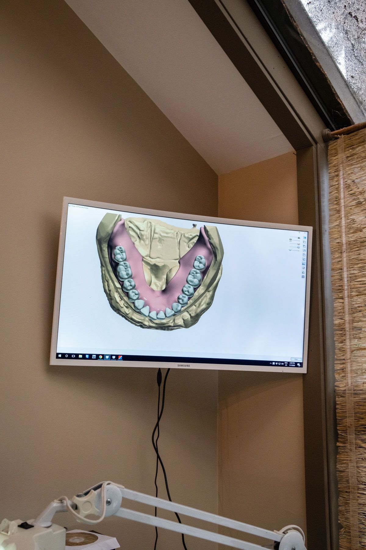 Digital Impressions — Everett, WA — Laney Dental
