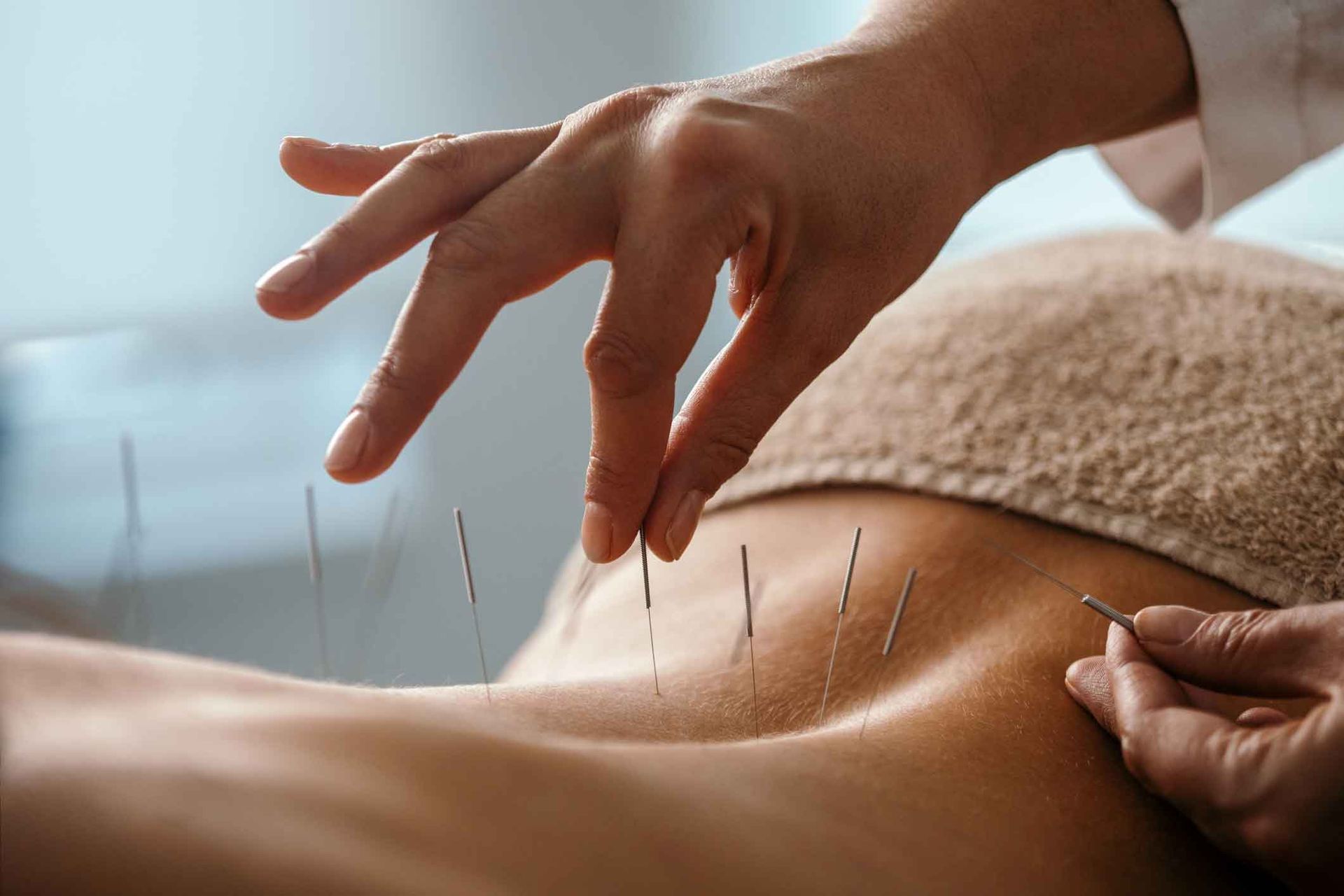 A person is getting acupuncture on their back.