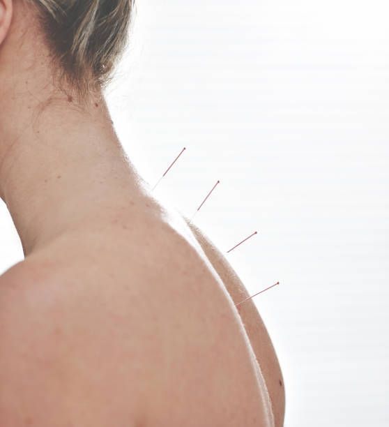 A woman is getting acupuncture on her back.