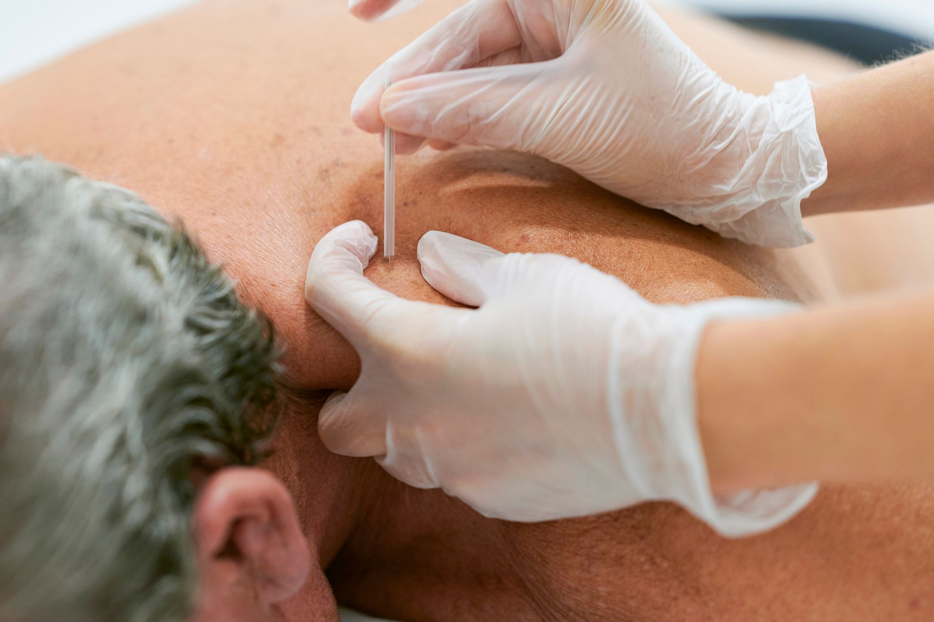 A woman is getting acupuncture on her arm.