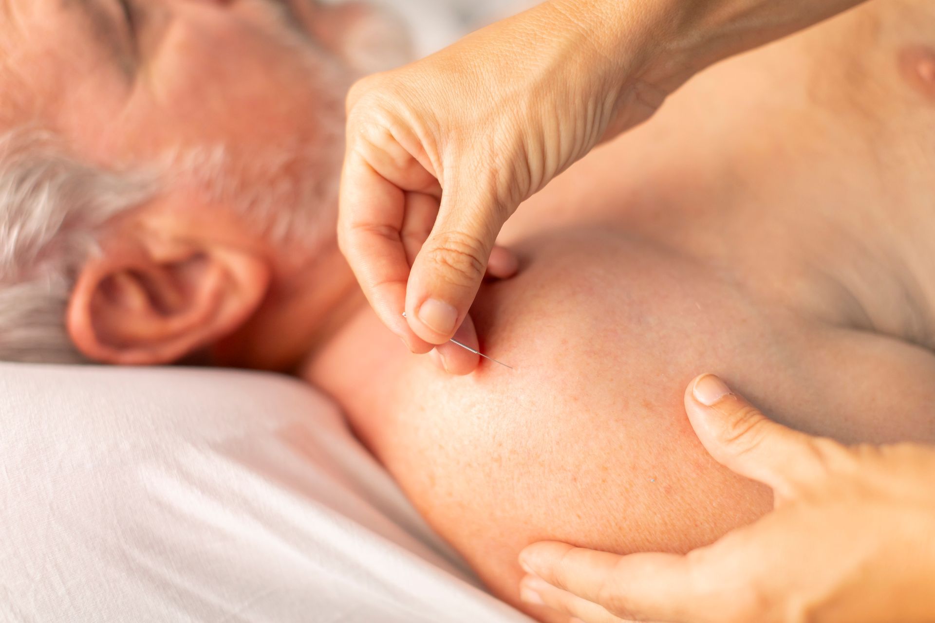A woman is getting acupuncture on her back.
