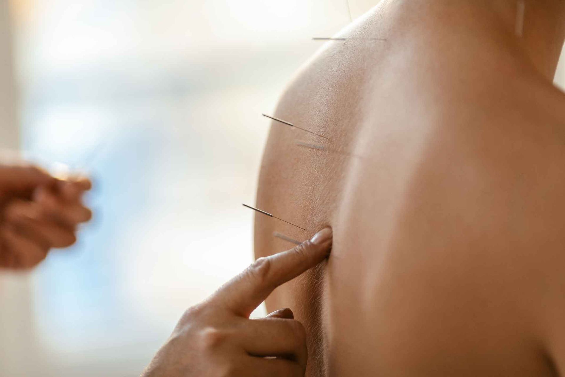 A person is getting acupuncture on their back.