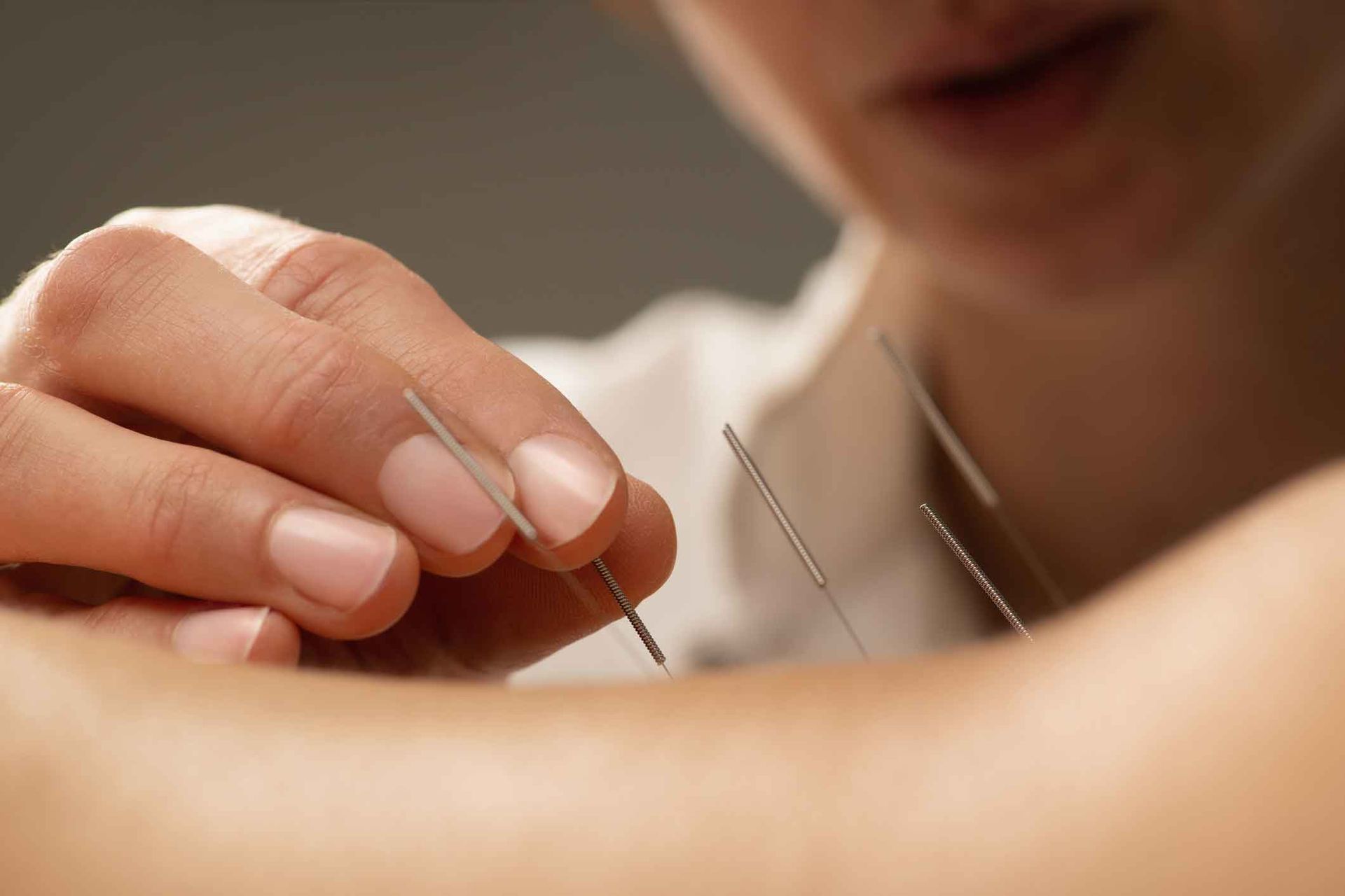 A woman is getting acupuncture on her arm.