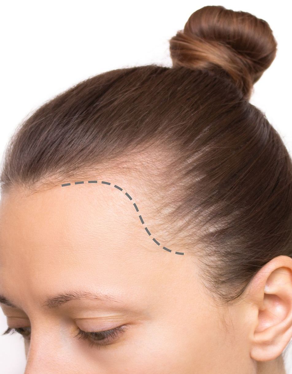 Sunekos Haarausfall Augenbrauen Haaransatz