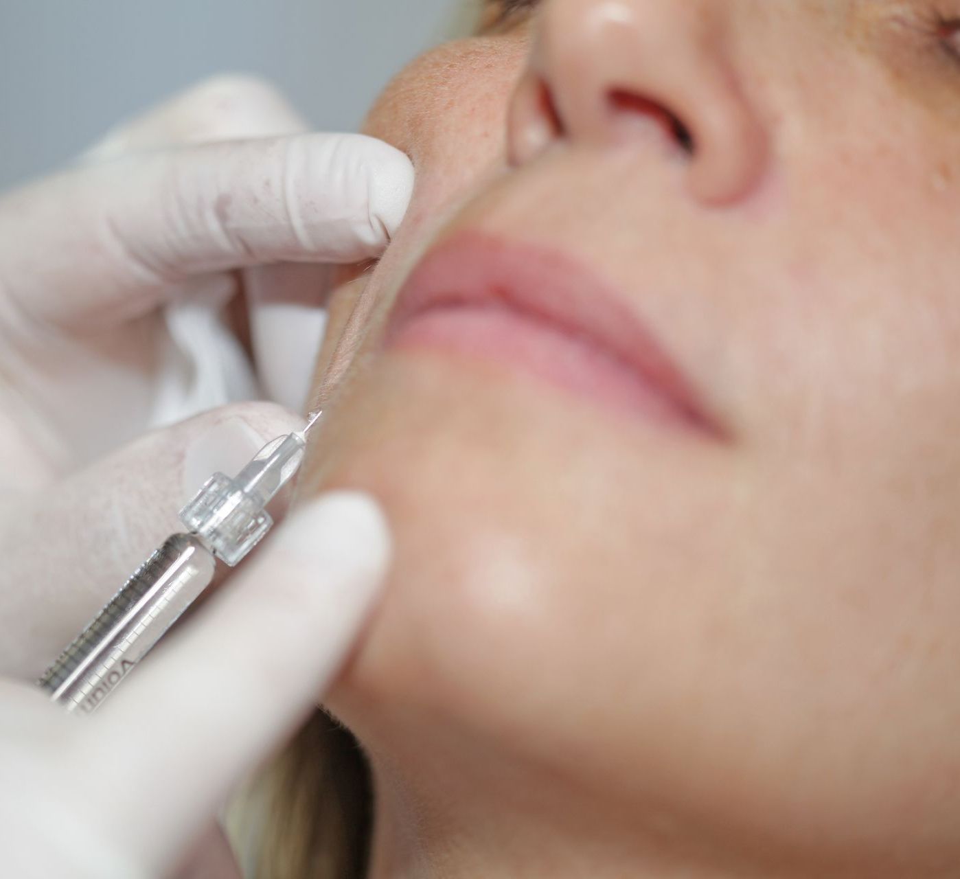 Profhilo Filler Nasolabialfalte