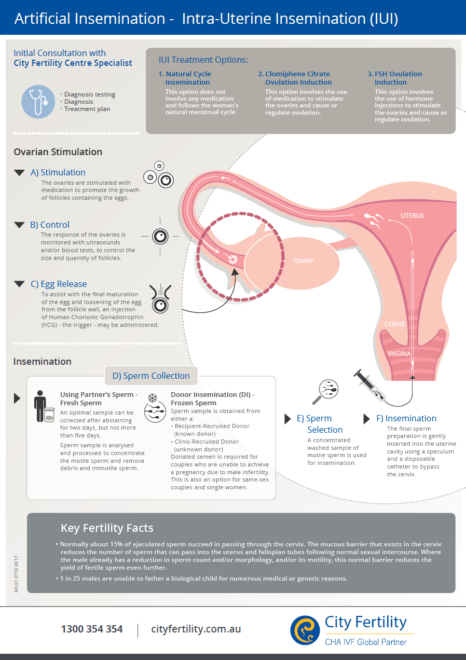 A Step By Step Guide To Intrauterine Insemination Iui Precision Ivf