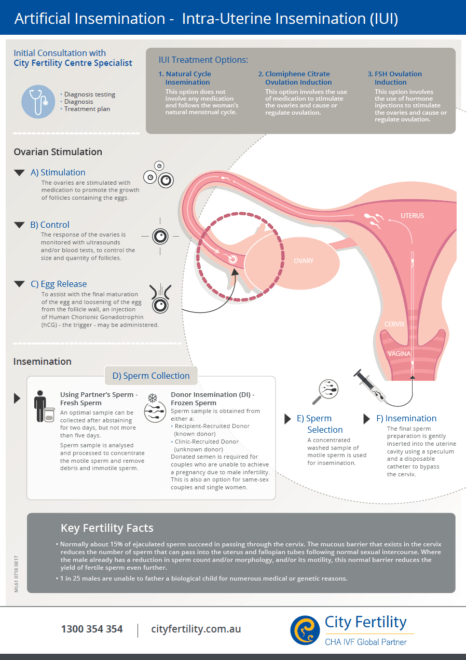 Symptoms of IUI Pregnancy  Signs of Intra Uterine Insemination