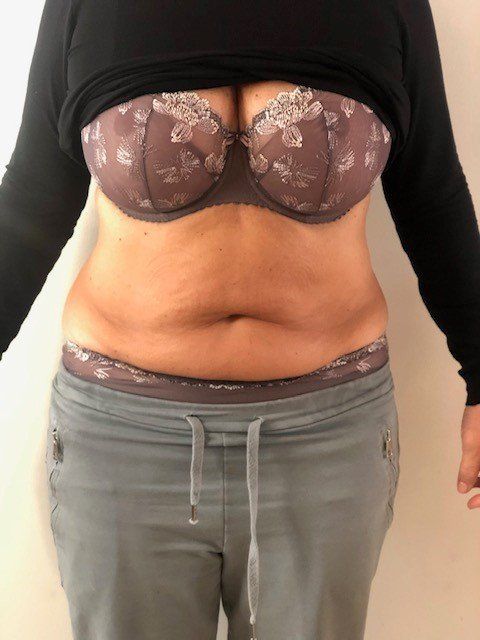 U-nique Magshape Bodysculpting efter behandling