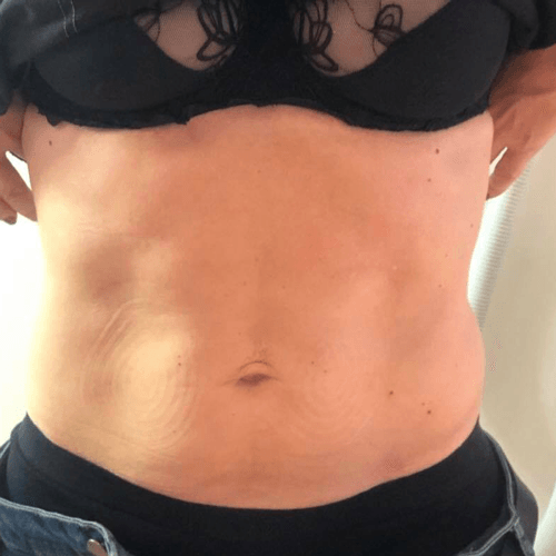 U-nique Magshape Bodysculpting efter behandling