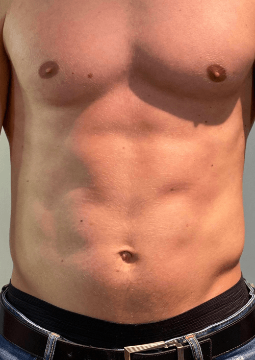 U-nique Magshape Bodysculpting efter behandling