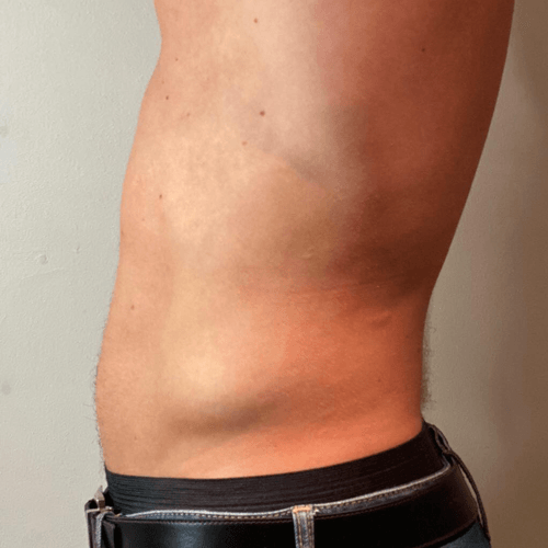 U-nique Magshape Bodysculpting efter behandling