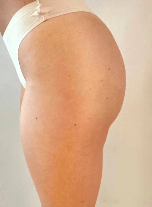U-nique Magshape Bodysculpting efter behandling