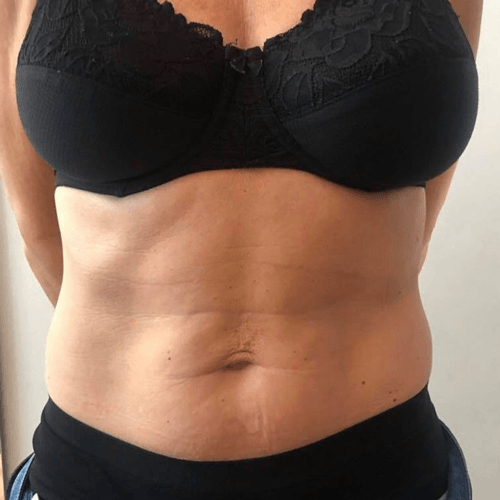 U-nique Magshape Bodysculpting før behandling