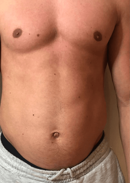 U-nique Magshape Bodysculpting før behandling