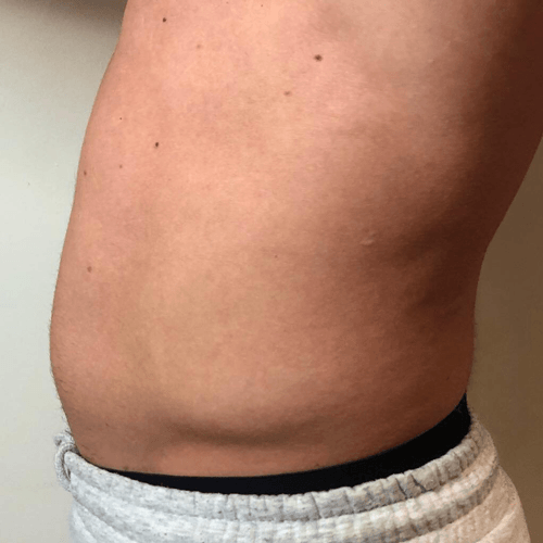 U-nique Magshape Bodysculpting før behandling