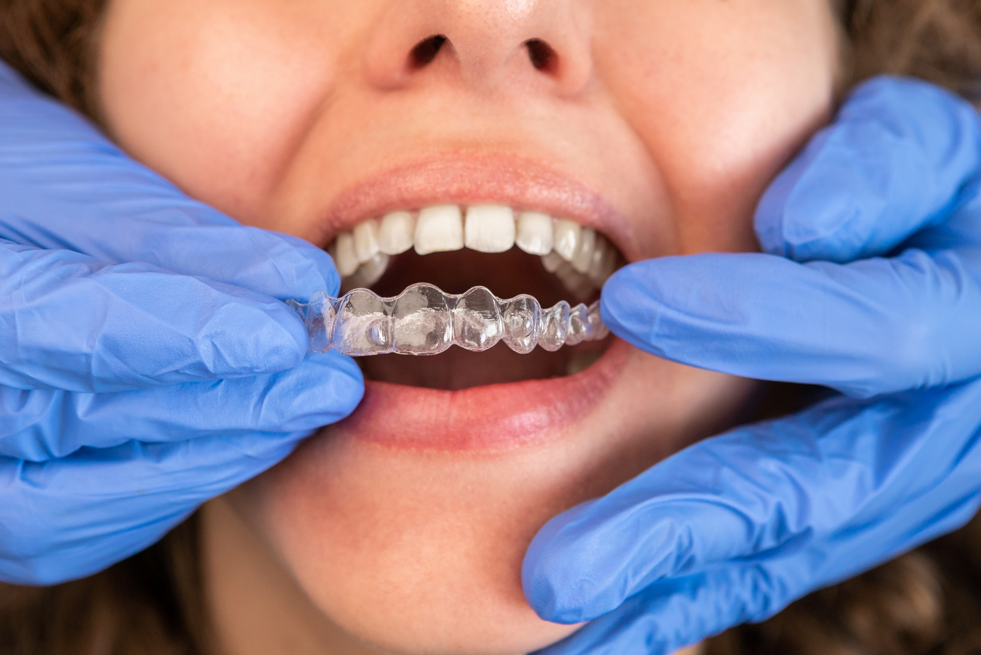 A woman is getting her teeth straightened by a dentist.