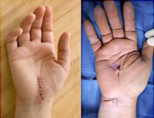 Open and endoscopic carpal tunnel surgery scars.