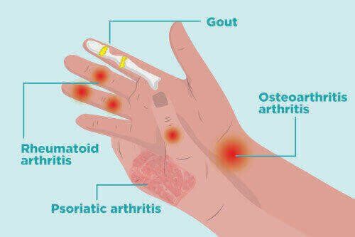 Diagram of where arthritis in the hand occurs.