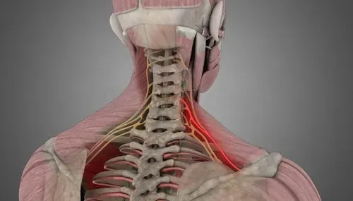 Diagram of a pinched nerve or cervical radiculopathy.