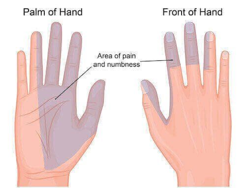 area of carpal tunnel pain and numbness