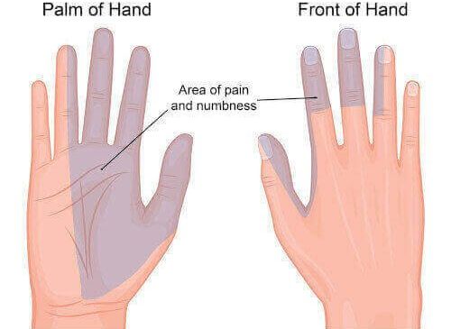 where carpal tunnel is felt on the hand