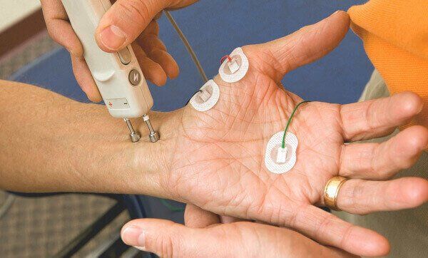 nerve conduction test for carpal tunnel syndrome