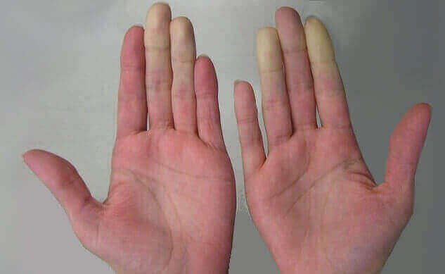 Raynaud's phenomenon can mimic symptoms of carpal tunnel syndrome.